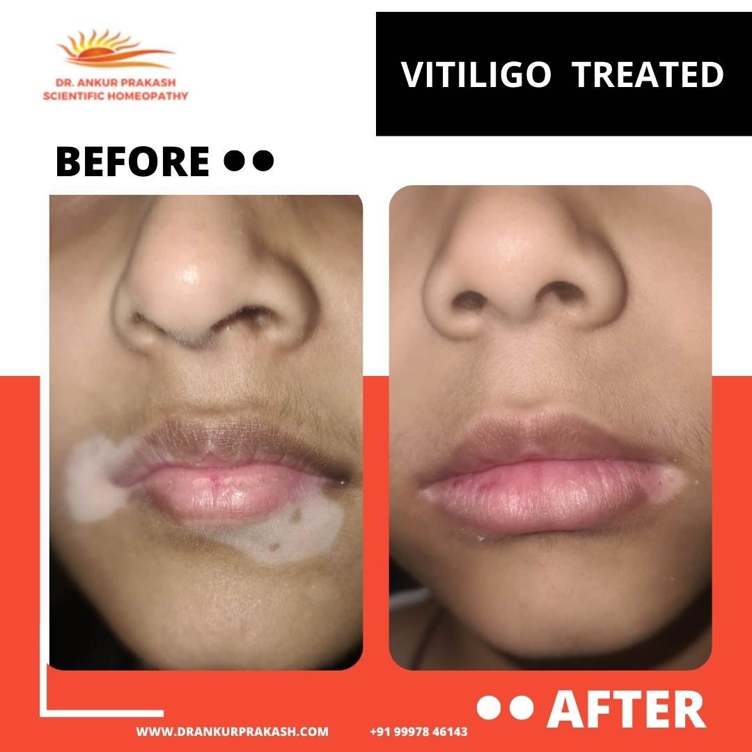 Vitiligo Treated Before/After Report