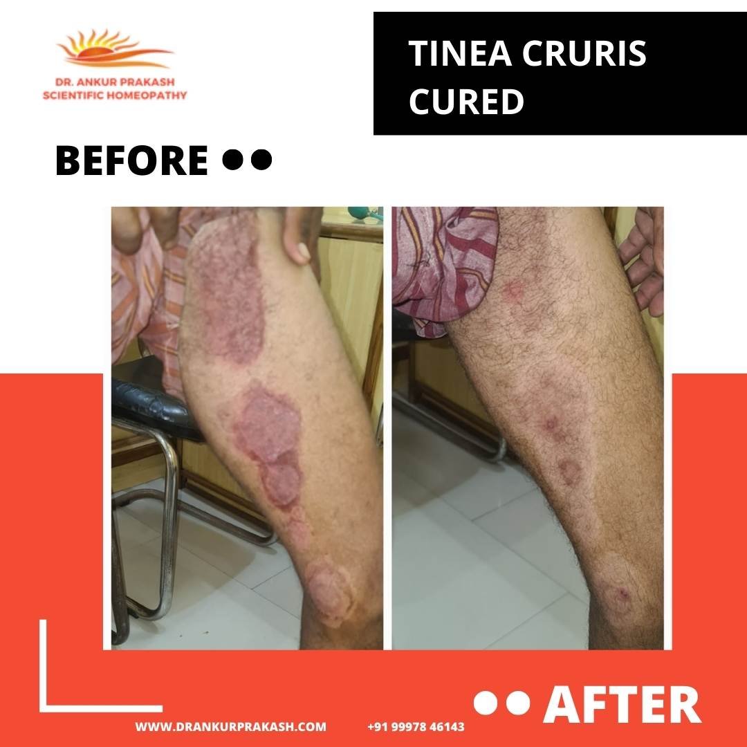 Tinia Cruris Cured by DR. Ankur Prakash Scientific Homeopathy