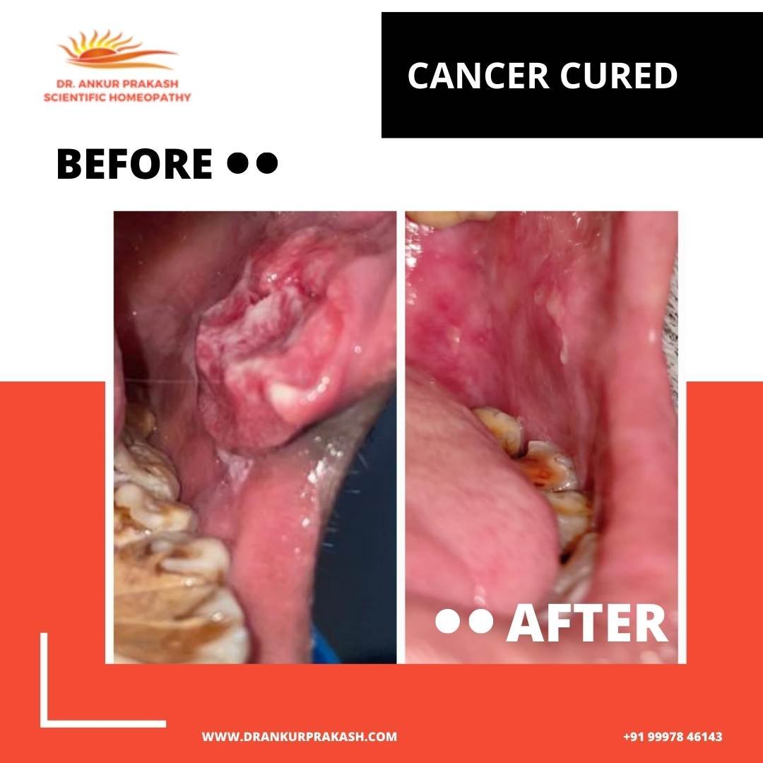Cancer Cured by DR. Ankur Prakash Scientific Homeopathy