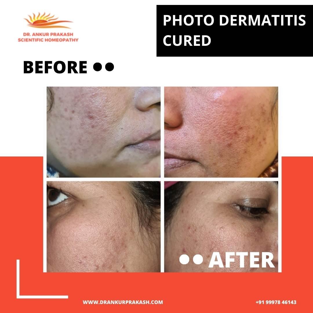Photo Dermatitis Cured by DR. Ankur Prakash