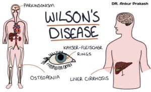 Wilson's Disease