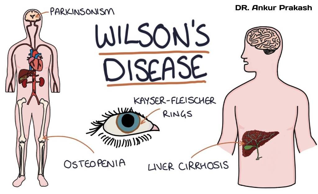 Homeopathic Approach For Wilson s Disease Rare Genetic Disorders Homeopathic Approach For Wilson s Disease Rare Genetic Disorders