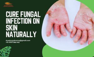 Fungal Infection two hands.