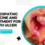An advertisement for homeopathic medicine and treatment for mouth ulcers featuring a close-up image of a mouth with visible ulcers.