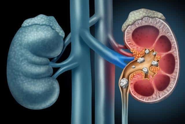 Understanding Kidney Stones