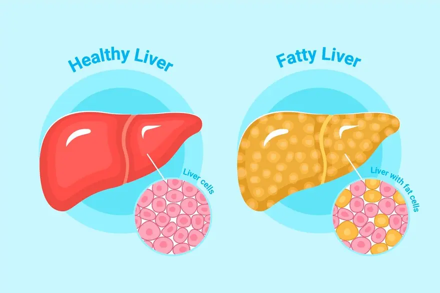 types of fatty liver