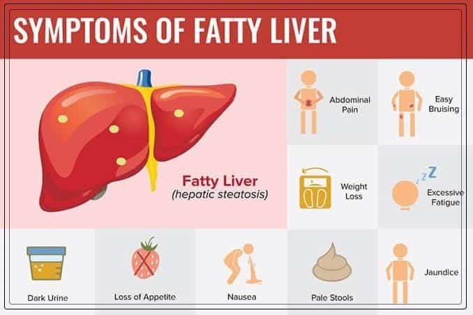 What Are the Symptoms of Fatty Liver?