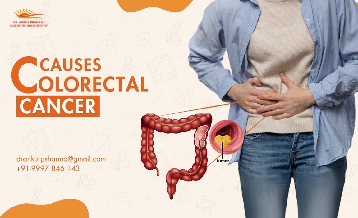 A visual representation of colorectal cancer showing a diagram of the colon with a tumor