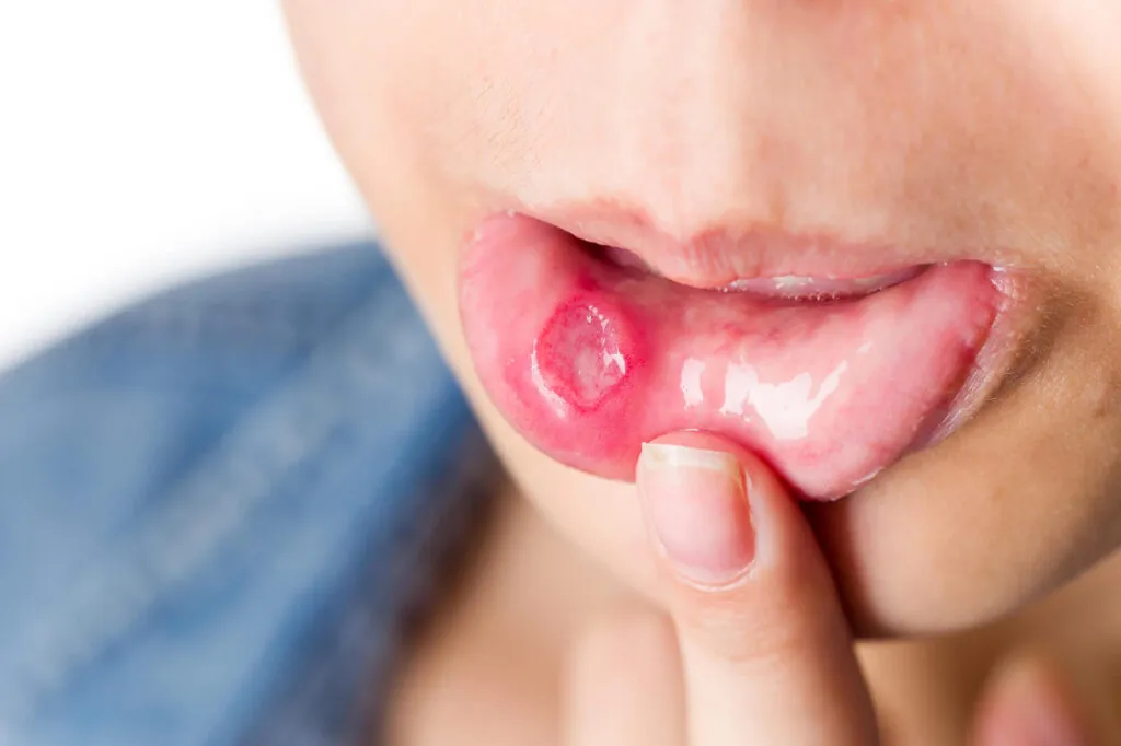 Oral Cancer Last-Stage Symptoms