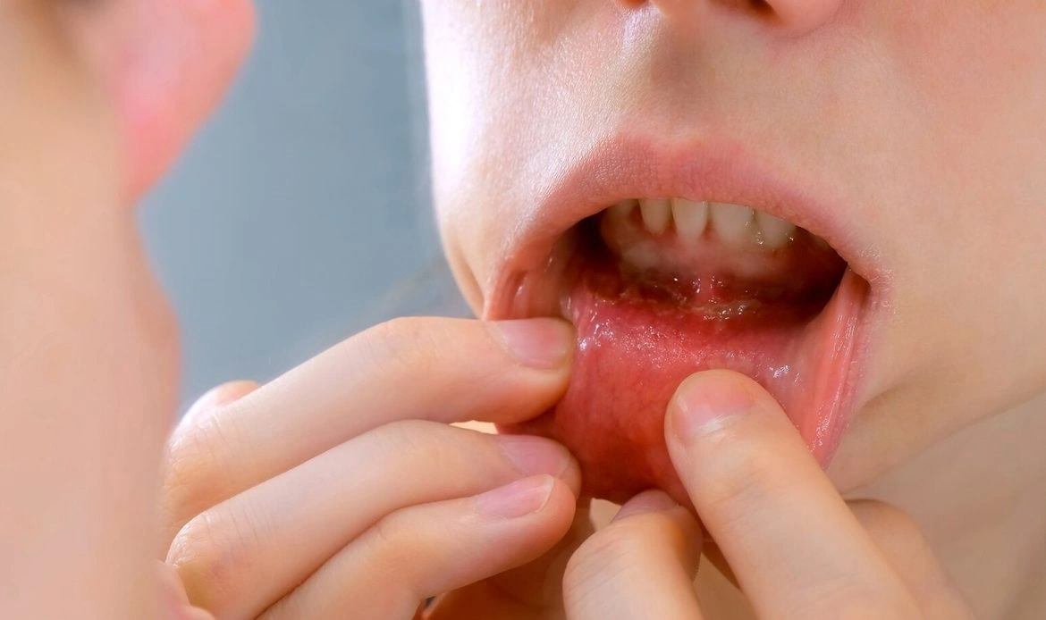 oral cancer