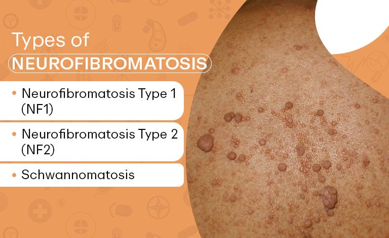 Close-up image of skin affected by Neurofibromatosis