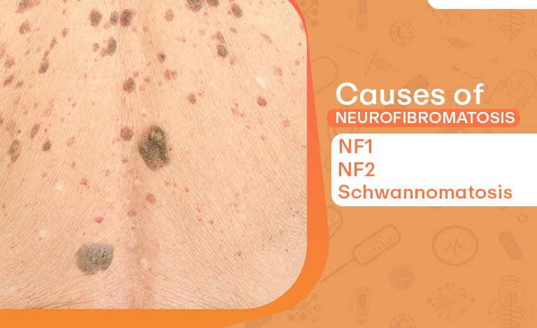 Close-up image of skin with Neurofibromatosis showing its causes