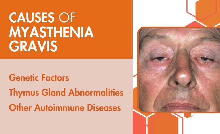 Image of a person with drooping eyelids highlighting the causes of Myasthenia Gravis