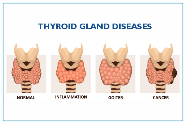 Thyroid Cancer Diseases