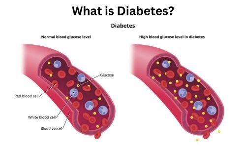 what is Diabetes?