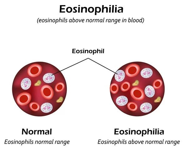 What Are Eosinophils