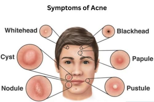 Symptoms of Acne