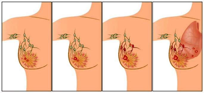 causes breast cancer