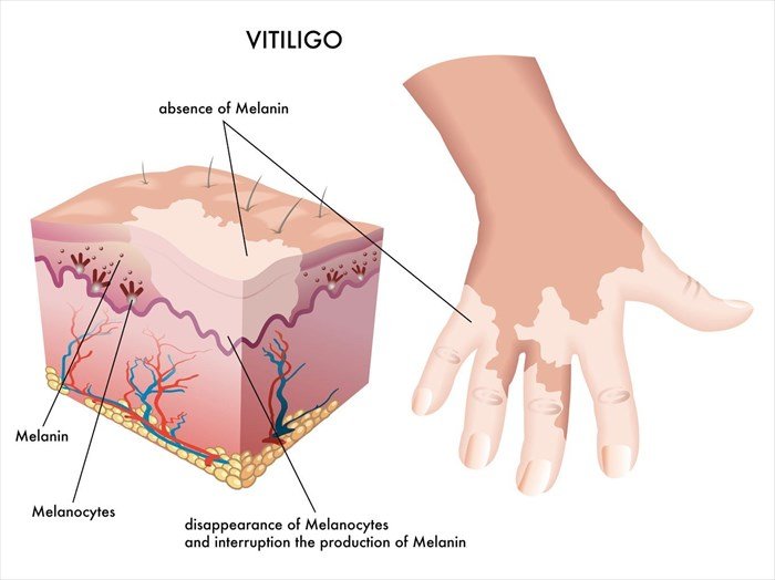 Vitiligo Disease