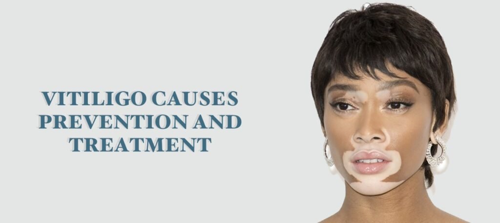 Causes of Vitiligo