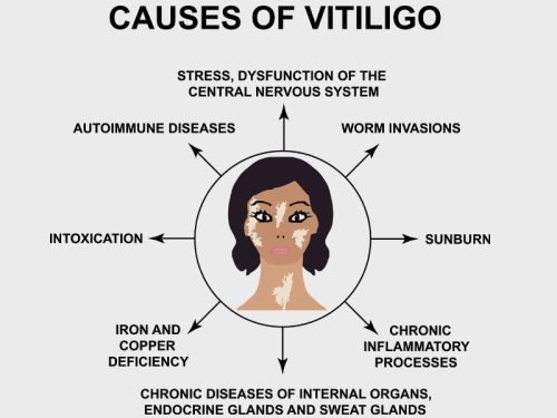 Causes of Vitiligo