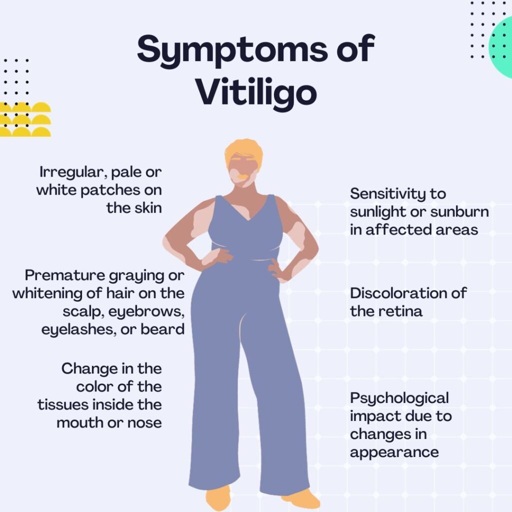 Symptoms of Vitiligo