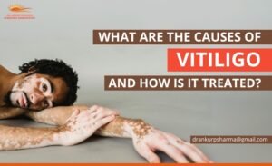 Causes of Vitiligo, and It's Treatment