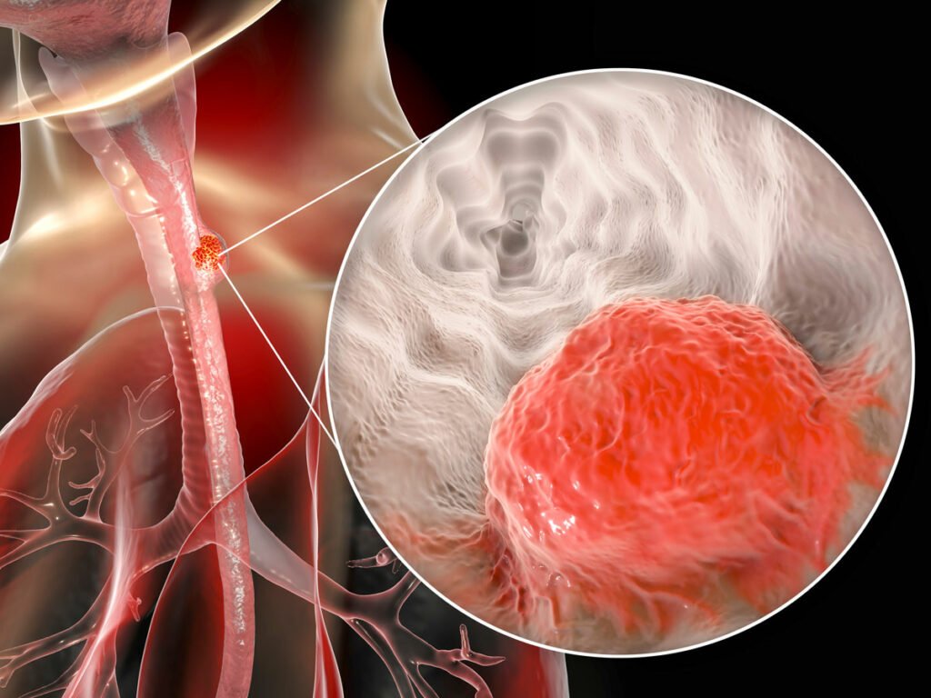Cancer Symptoms