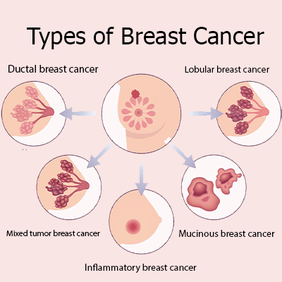 Breast cancer types