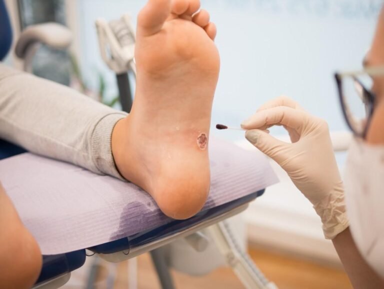Plantar Warts