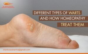 Types of Warts