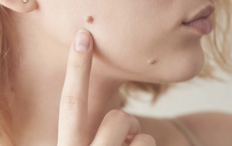 Warts on Face