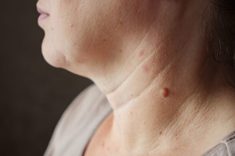 What Are Warts