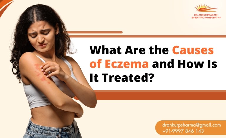 What Are the Causes of Eczema and How Is It Treated?