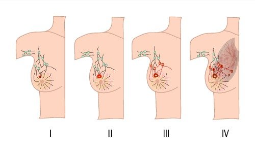 How is Cancer Staged?