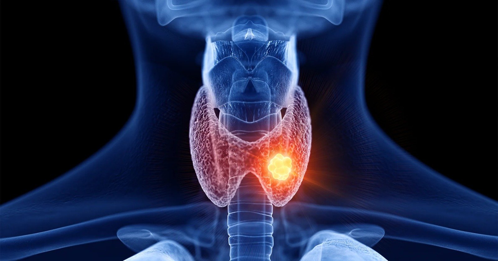 Possible complications of untreated high TSH