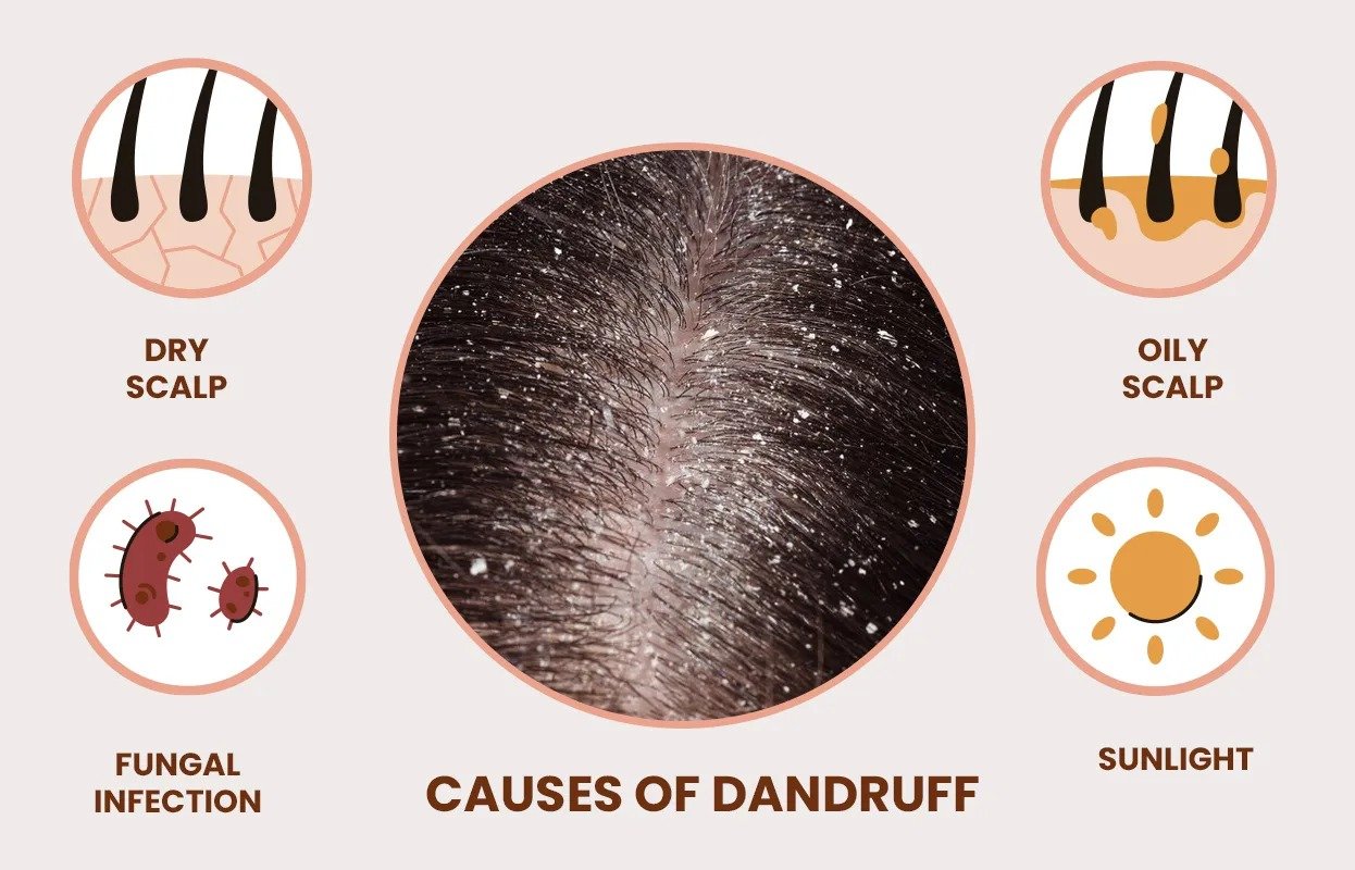 Causes of Dandruff in Hair