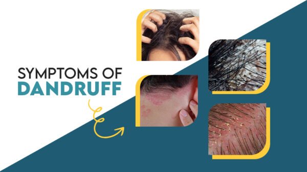 What Are the Symptoms of Dandruff?