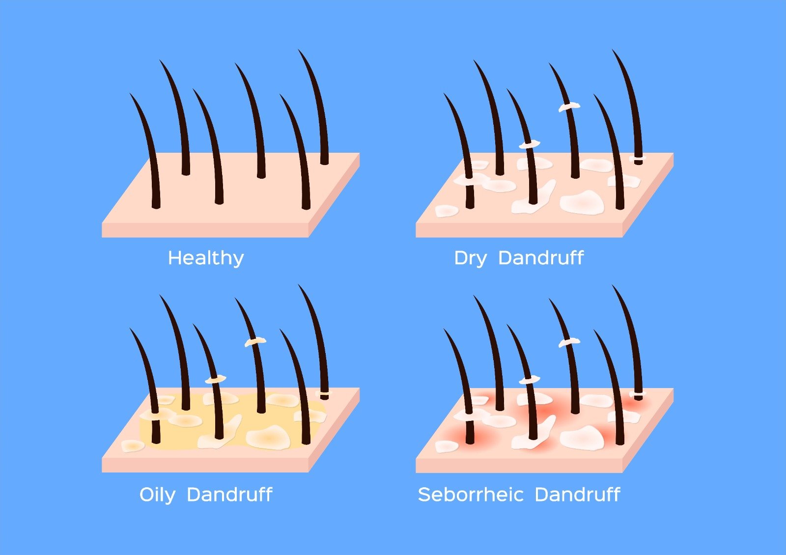 Types of Dandruff in Hair