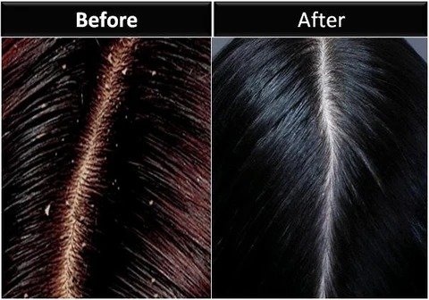 How to Cure Dandruff Permanently?