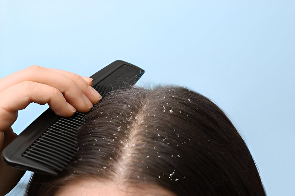 What is Dandruff?
