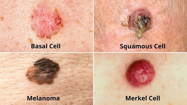 What About Viruses That Can Lead to Cancer?