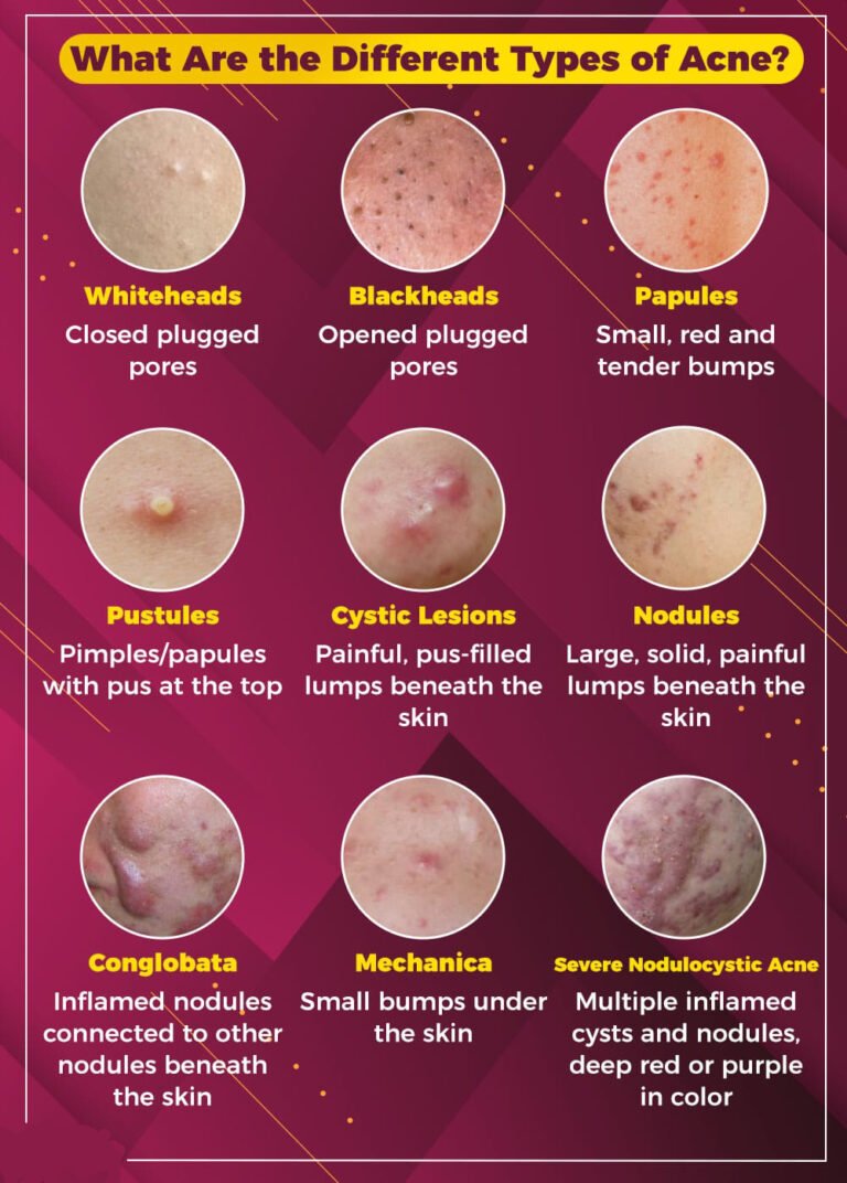 Causes of Acne