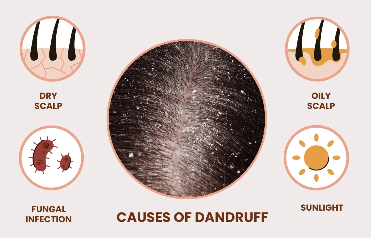 Causes of Dandruff in Hair