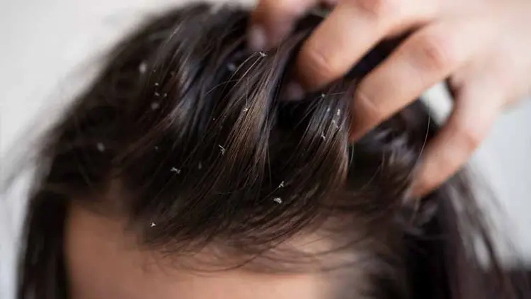 How to Prevent Dandruff?