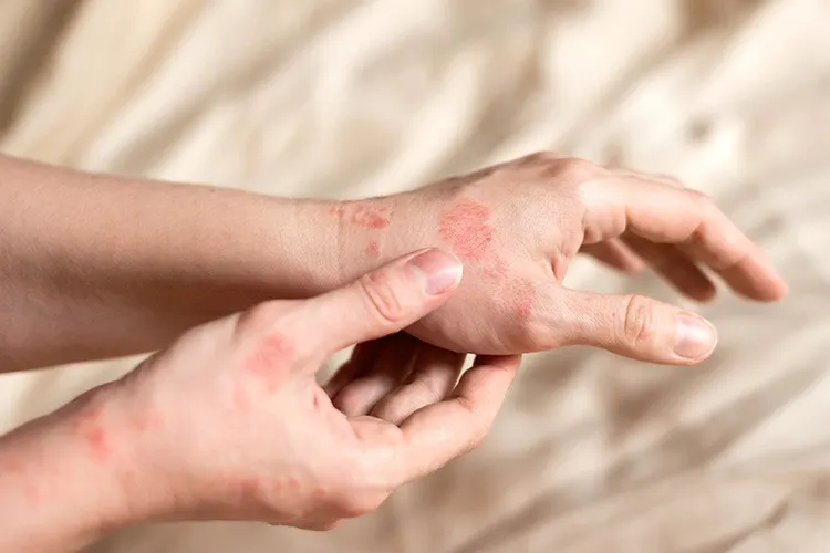 How to Get Rid of Eczema