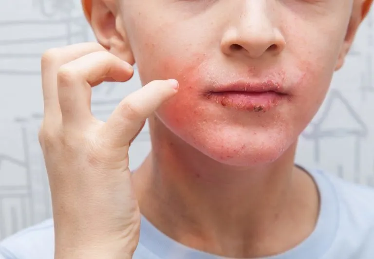 Why Does Eczema Happen?
