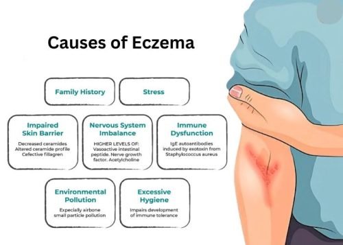 Causes of Eczema