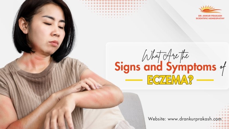 What Are the Signs and Symptoms of Eczema?