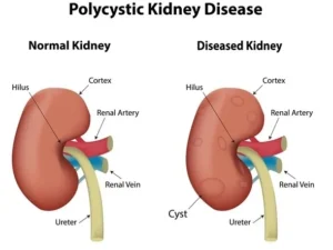 Symptoms of Kidney Cyst